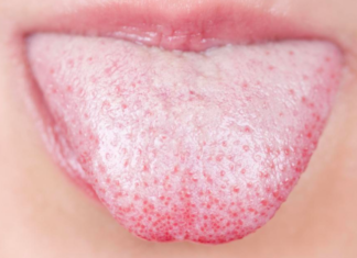 THIS is what a white tongue says about your health! Very few people know this!